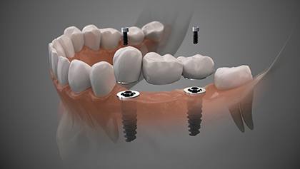 Illustration of three-unit dental implant bridge