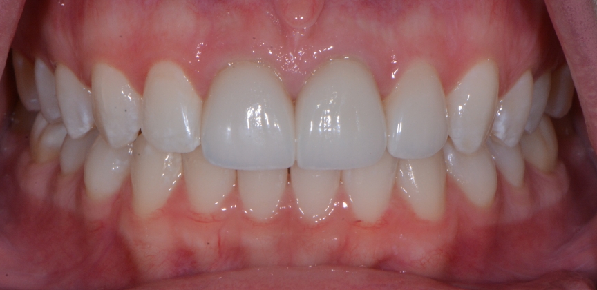 Discolored smile before treatment treatment