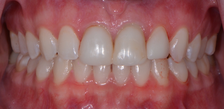 Healthy bright natural looking some after cosmetic dentistry treatment