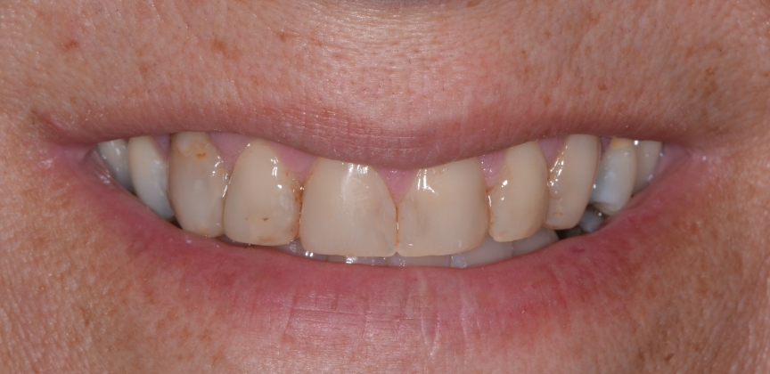 White healthy smile after cosmetic dental treatment