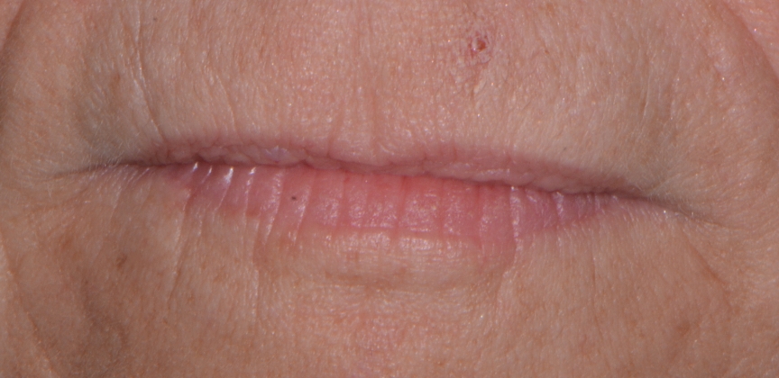 Smooth youthful skin around mouth after Botox treatment