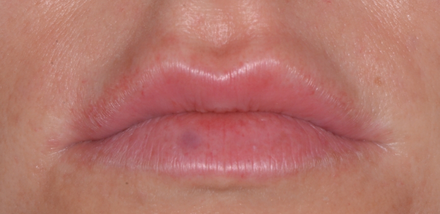 Lips before dermal filler treatment