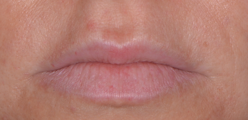 Plump lips after dermal filler treatment