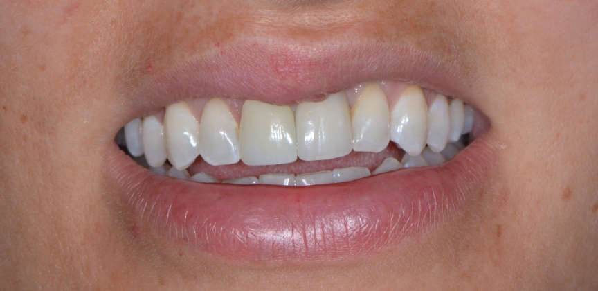 Yellowed smile before teeth whitening treatment