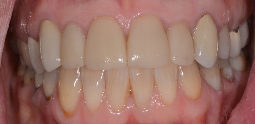 Severely decayed and damaged smile before restorative dental treatment