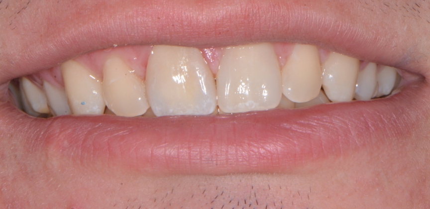 Smile with worn and damaged front tooth before treatment