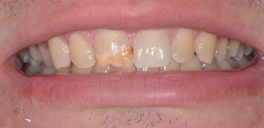 Perfected smile after damaged front tooth was repaired