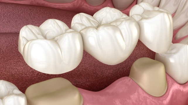 Animated dental bridge replacing a missing tooth