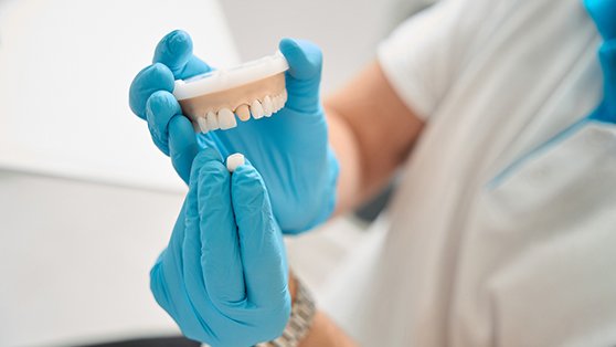 Dental team member using model to explain dental crowns