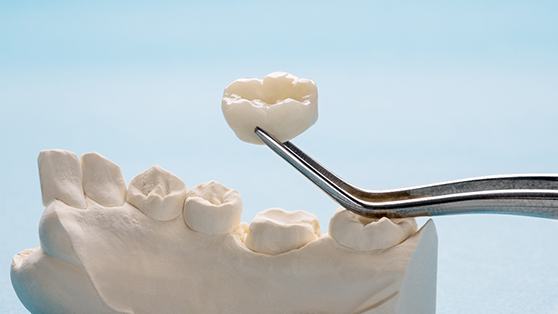 Dental forceps holding crown above tooth model