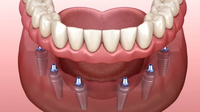 Six animated dental implants supporting a full denture