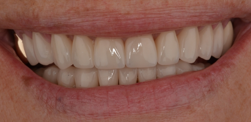 Smile with damaged decayed and missing teeth before dental treatment