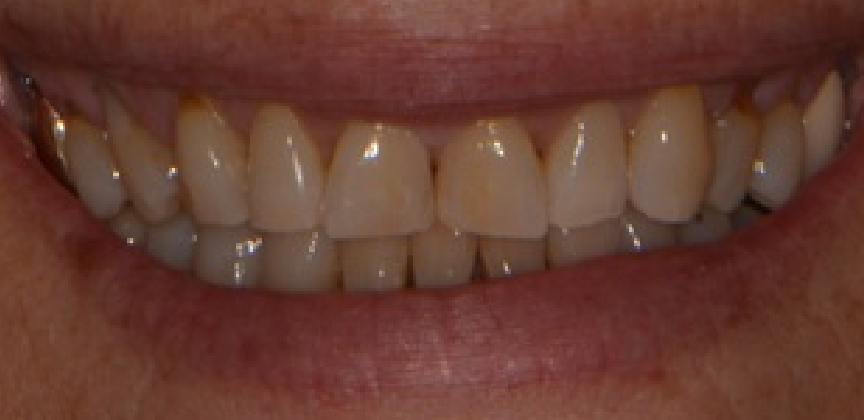 Smile after restorative dental treatment