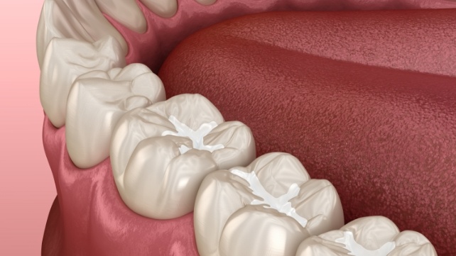 Animated row of teeth with tooth colored fillings
