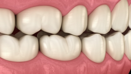 Animated healthy smile thanks to fluoride treatment to prevent tooth decay