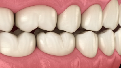 Illustrated upper and lower rows of teeth