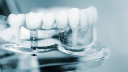 Model of the mouth with a dental bridge supported by two dental implants