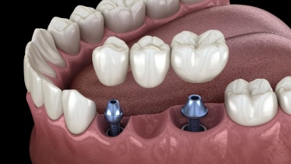 Animated dental bridge being placed onto two dental implants