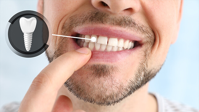 Person pointing to their tooth next to close up model of dental implant