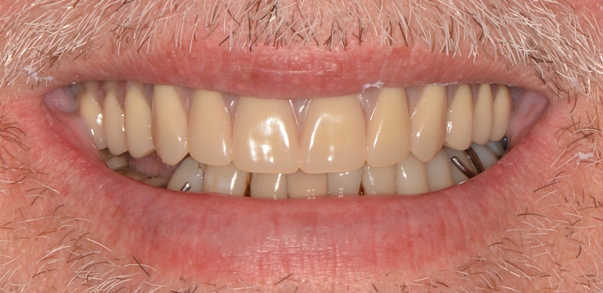  teeth before dental treatment