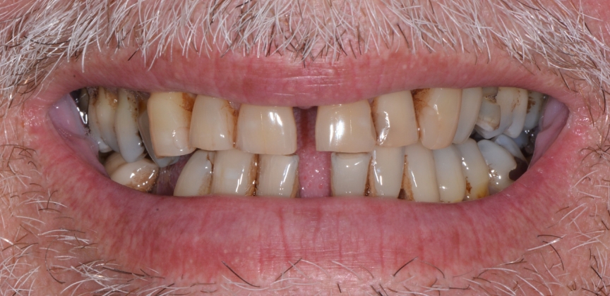 Smile after dental treatment