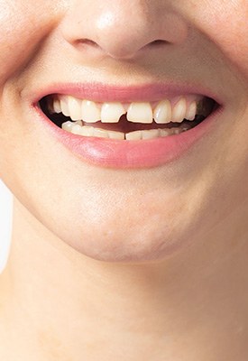 Repair cavities and broken teeth near Burlington
