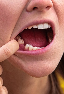 Replace missing teeth near Burlington