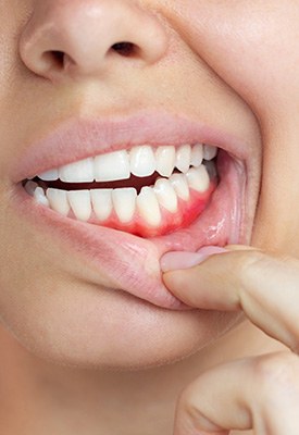 Treat gum disease near Burlington