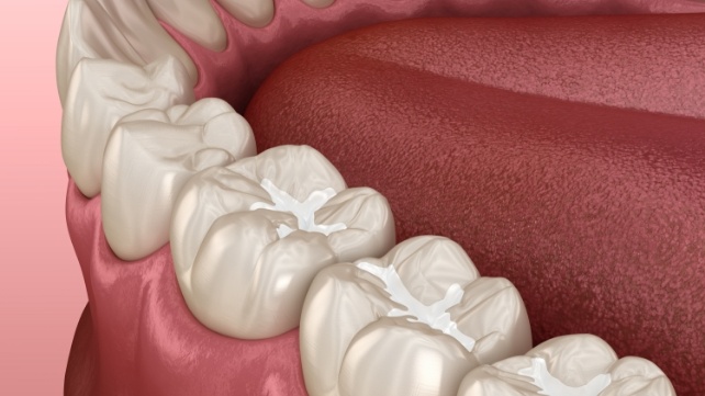 Animated smile with dental sealants