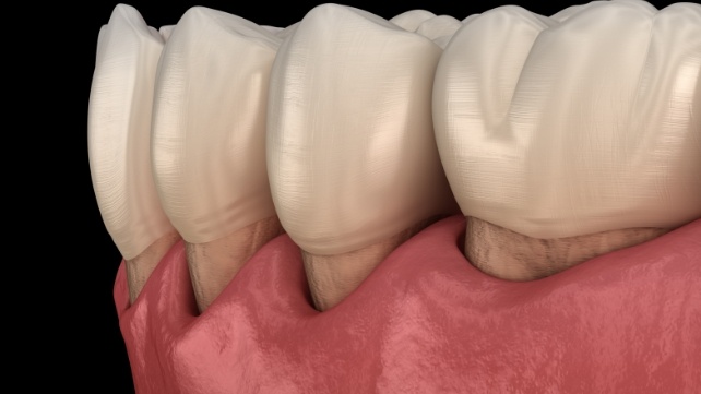 Animated smile with receding gums before gum disease therapy