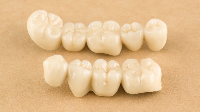 Two dental crown supported bridges prior to placement