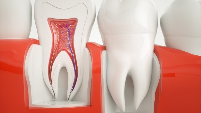 Model of the inside of a tooth in need of root canal treatment in Colchester
