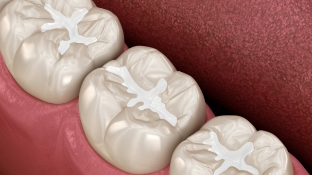 Animated row of teeth with dental sealants in Colchester