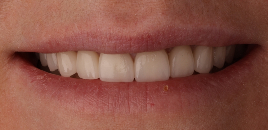 Smile with damaged decayed and missing teeth before dental treatment