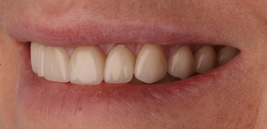 Smile with damaged decayed and missing teeth before dental treatment