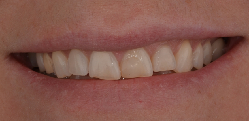 Smile after restorative dental treatment