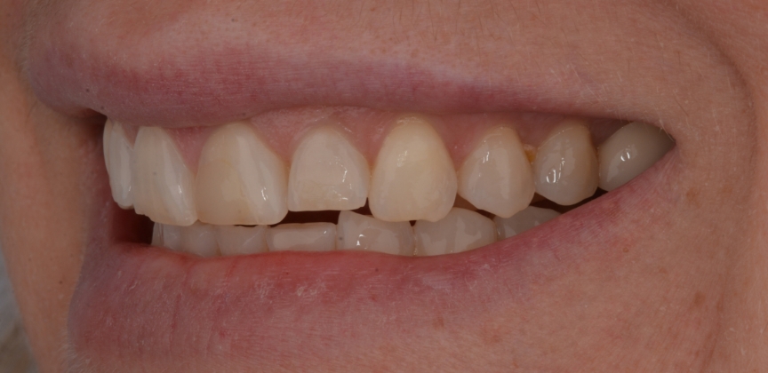 Smile after restorative dental treatment