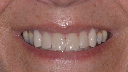After image of Porcelain Crowns