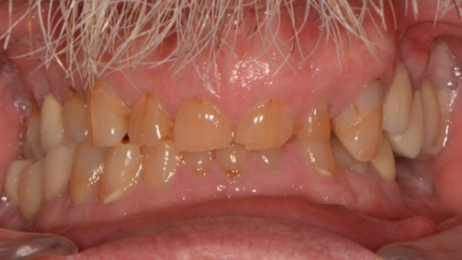 Before image of Porcelain Crowns