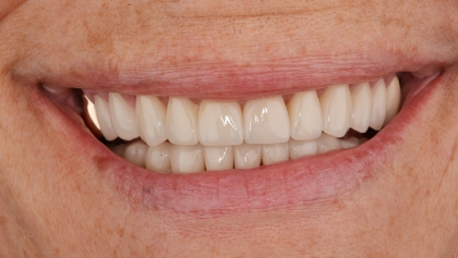 After image of Porcelain Crowns