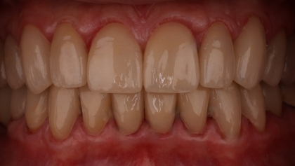 After image of Full Mouth Crowns
