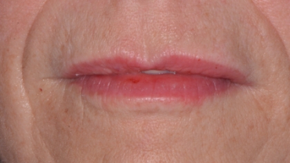 After image of Lip Dermal Filler