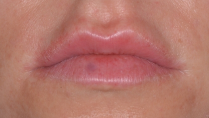 After image of Lip Dermal Filler