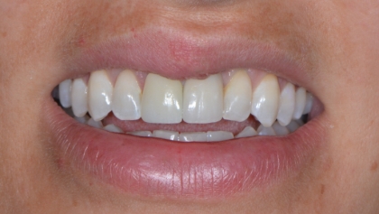 After image of Replacement Of Old Implant Crown