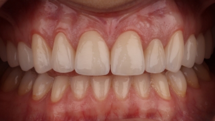 After image of Combination Of Veneers And Crowns