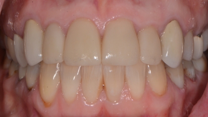 After image of Porcelain Crowns