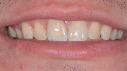 After image of Single Veneer
