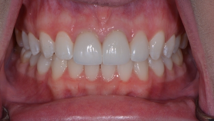 After image of Porcelain Veneers