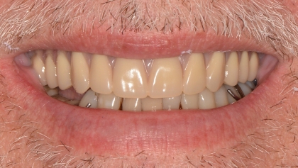 After image of Full Mouth Crowns