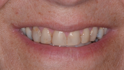 Before image of Porcelain Crowns